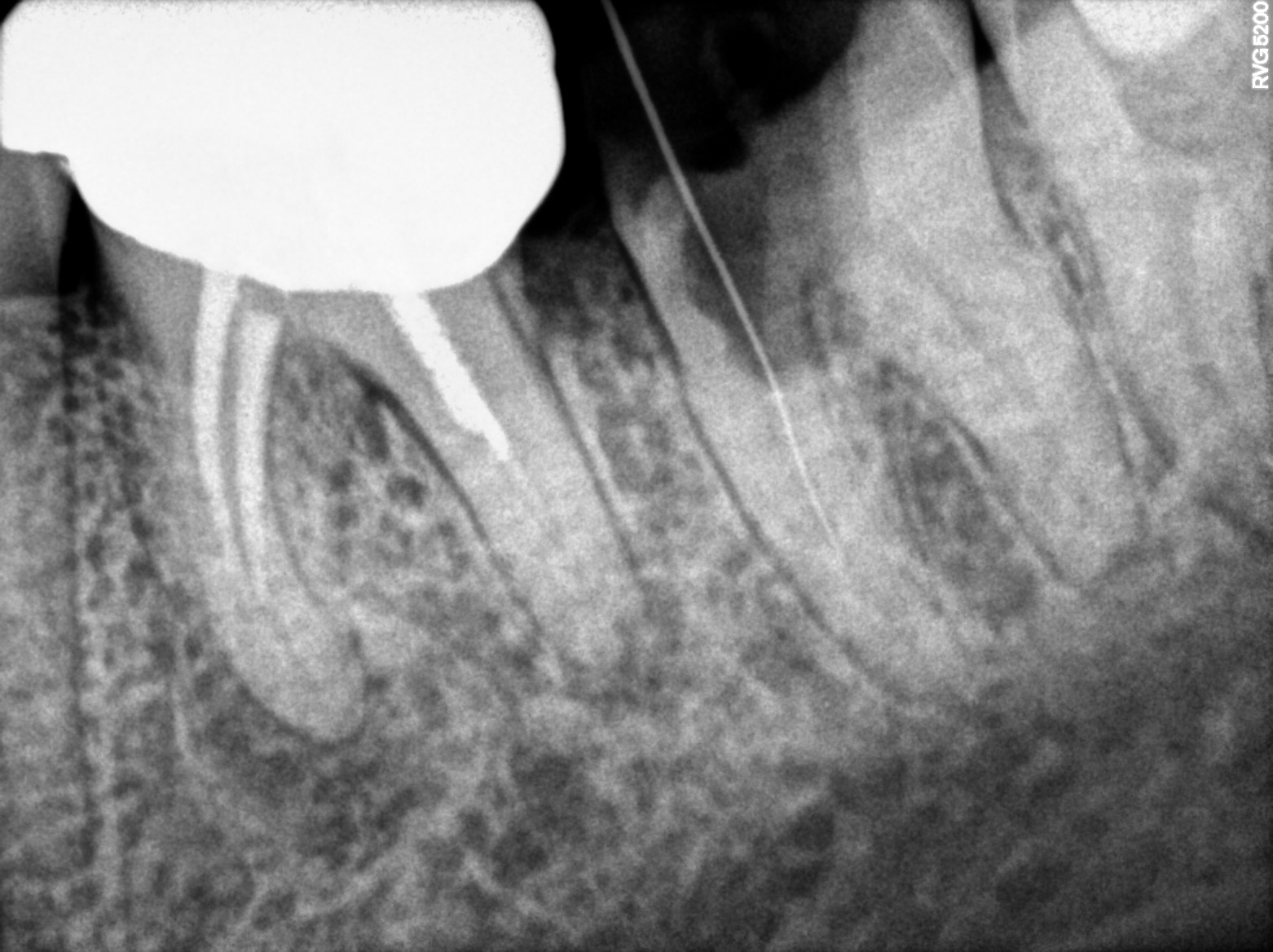 Dental X-ray